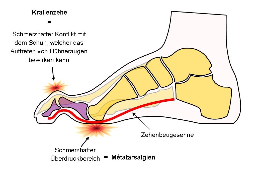 Skelettschema Fuß mit Krallenzehe